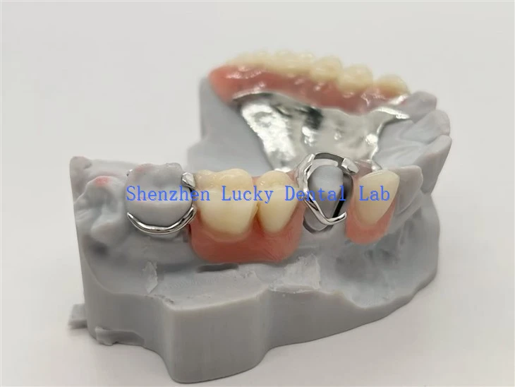 Prótese parcial metálica dentária