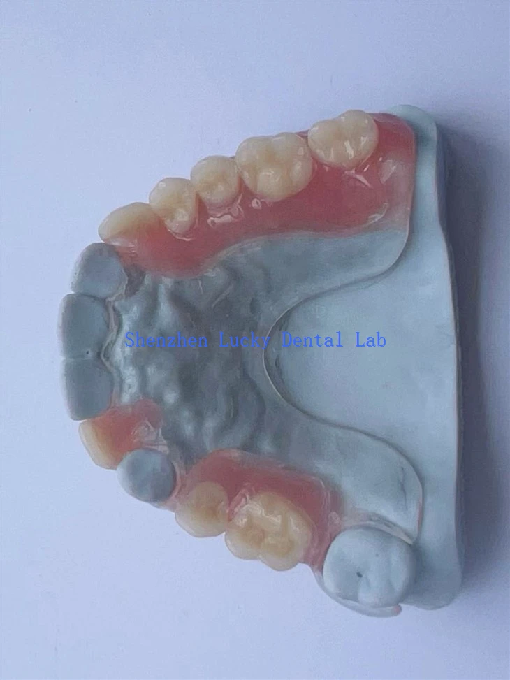 Estrutura Dental Clear confortável com próteses acrílicas