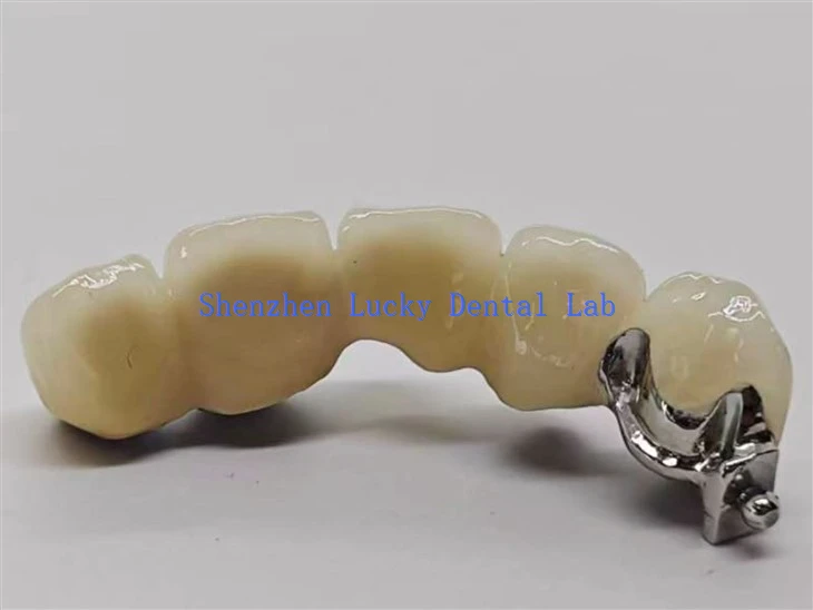 Dental PFM Bridge With Precision Ball Attachment Factory