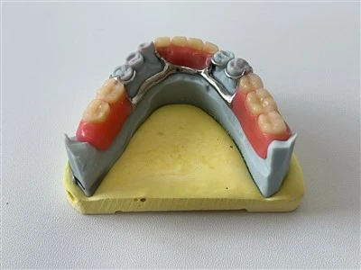 Barra de estrutura de metal dental de alta qualidade com dentadura acrílica feita na China